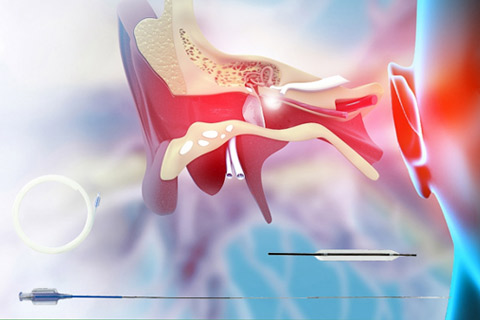 一次性使用咽鼓管球囊扩张导管